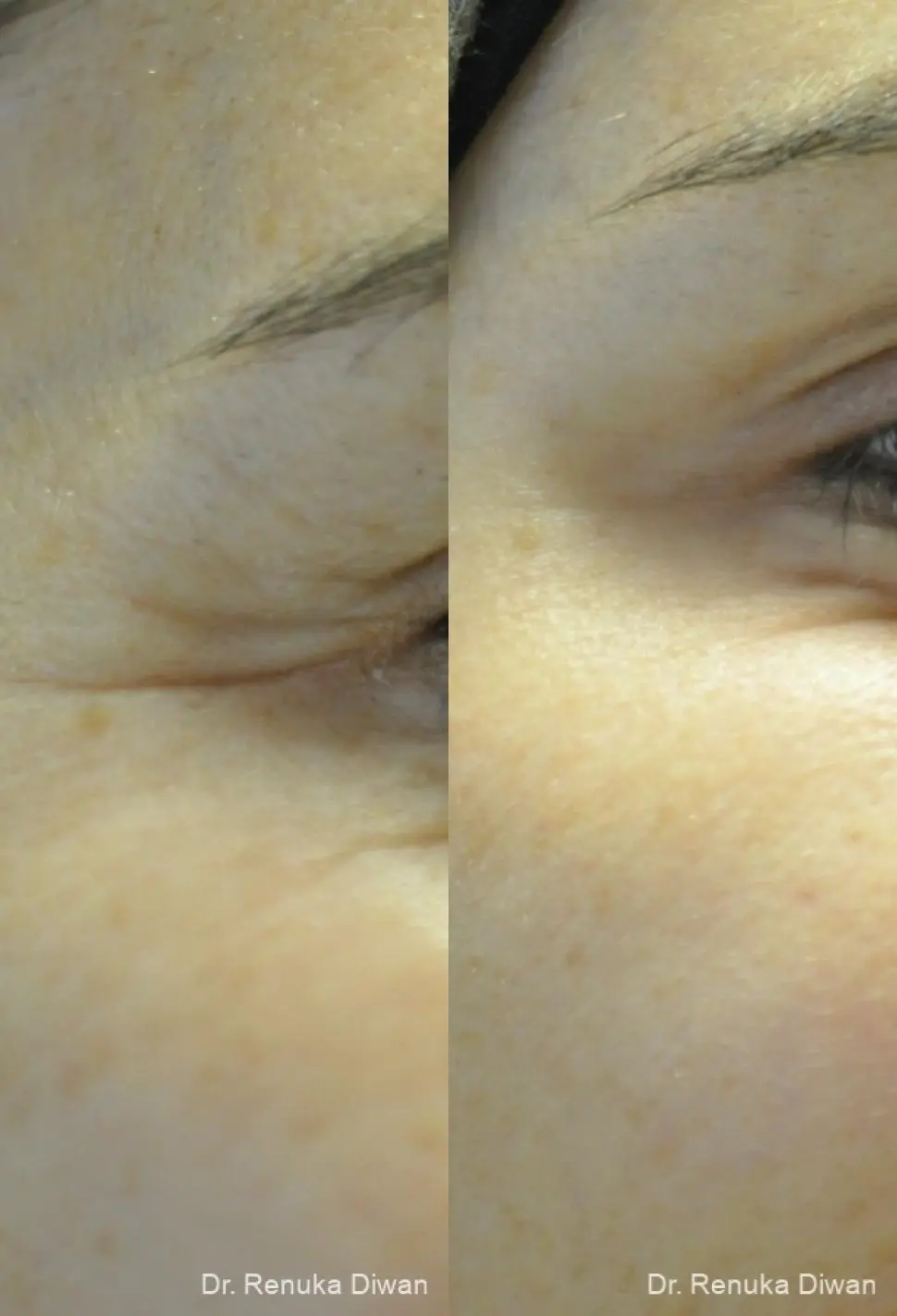 Crows Feet Creases: Patient 11 - Before and After 2