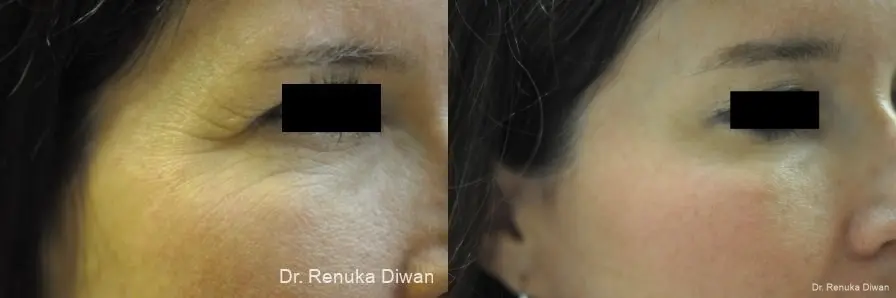 Crows Feet Creases: Patient 10 - Before and After  