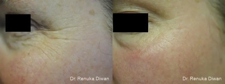 Crows Feet Creases: Patient 2 - Before and After  