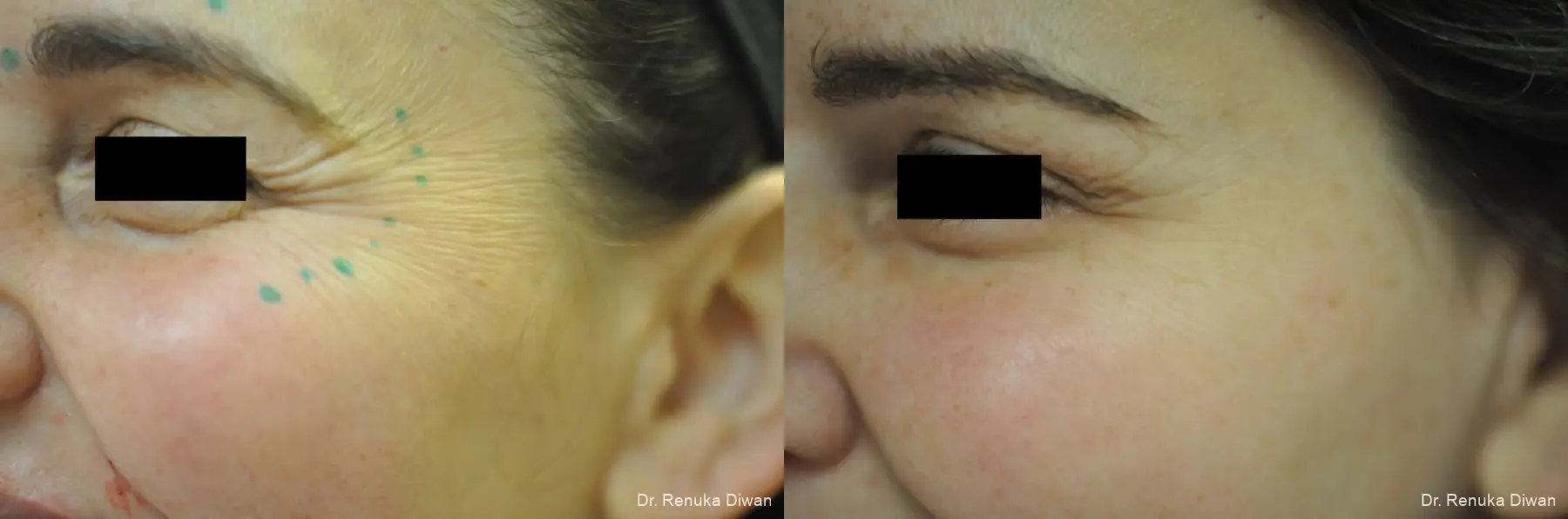 Crows Feet Creases: Patient 5 - Before and After  