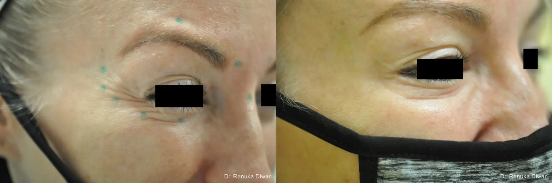 Crows Feet Creases: Patient 6 - Before and After 1