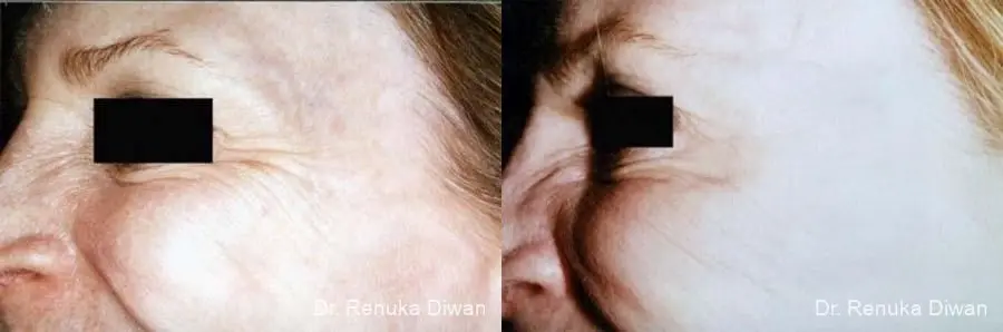 Crows Feet Creases: Patient 1 - Before and After 1