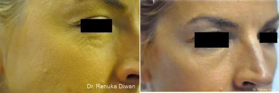 Crows Feet Creases: Patient 2 - Before and After 2