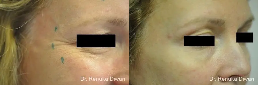 Crows Feet Creases: Patient 3 - Before and After 1
