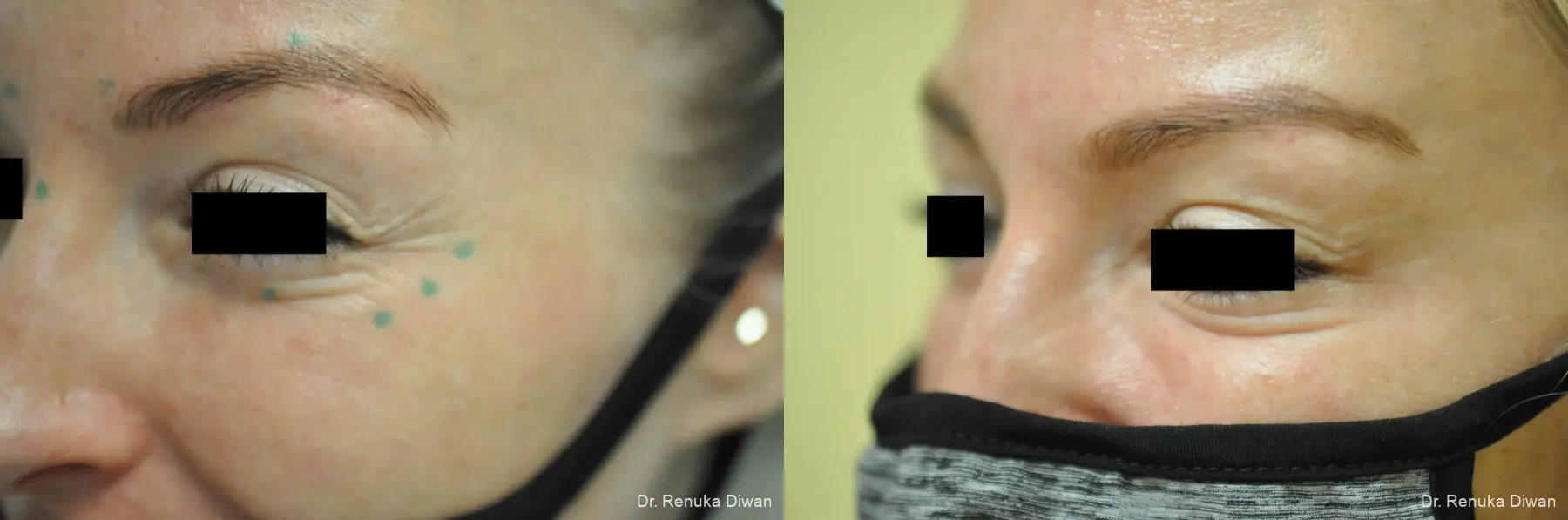 Crows Feet Creases: Patient 6 - Before and After 2