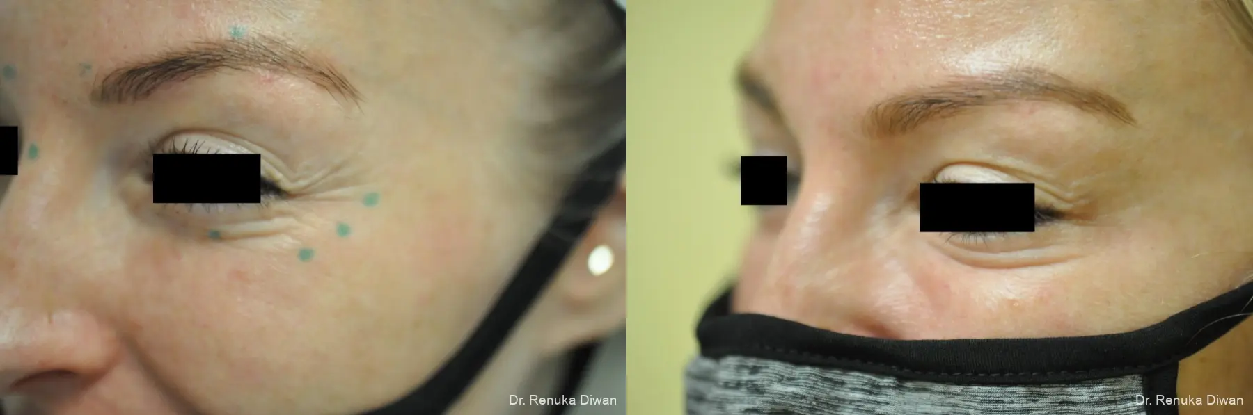 Crows Feet Creases: Patient 8 - Before and After 2