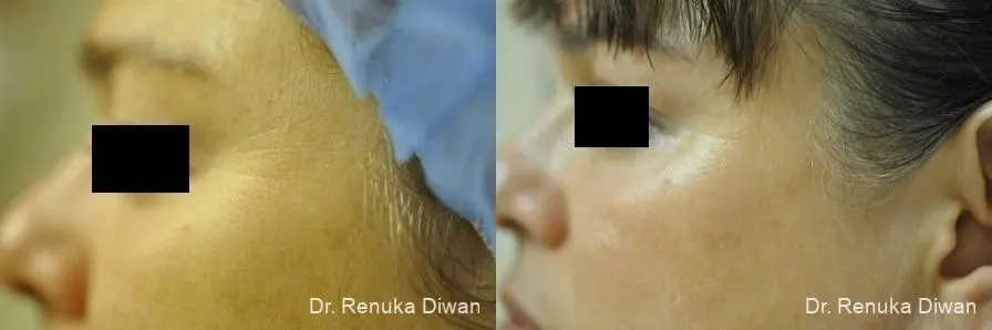 Crows Feet Creases: Patient 6 - Before and After  