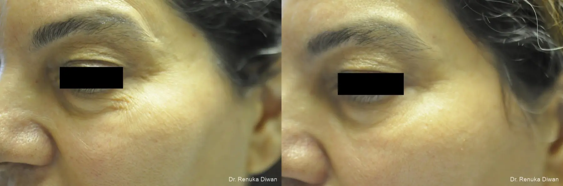 Crows Feet Creases: Patient 9 - Before and After 1