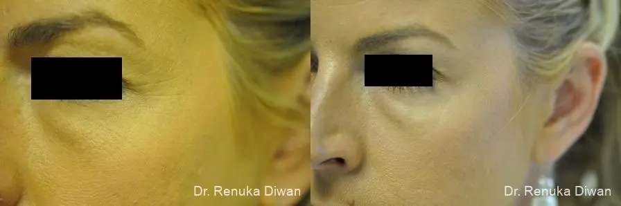 Crows Feet Creases: Patient 3 - Before and After  