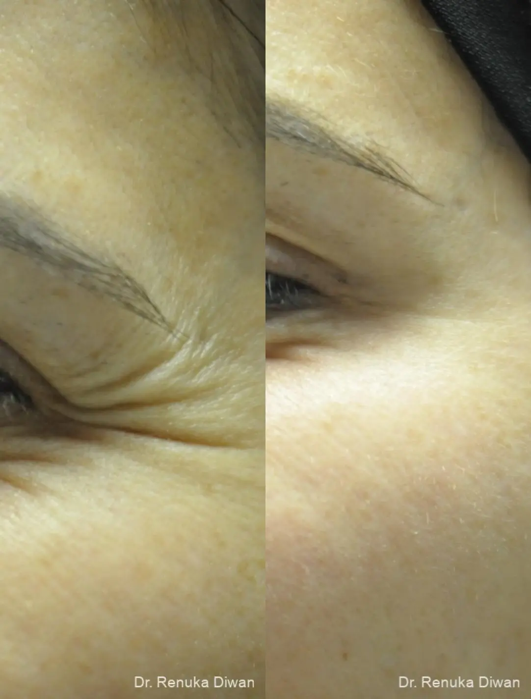 Crows Feet Creases: Patient 11 - Before and After 1