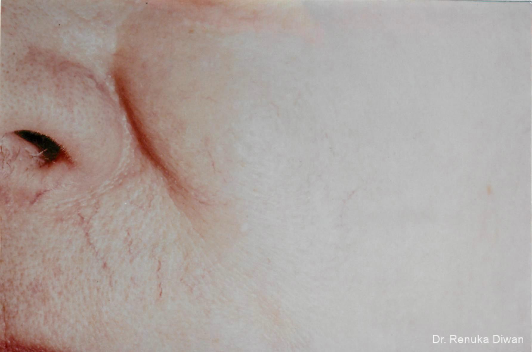 Laser For Veins And Redness: Patient 5 - Before 