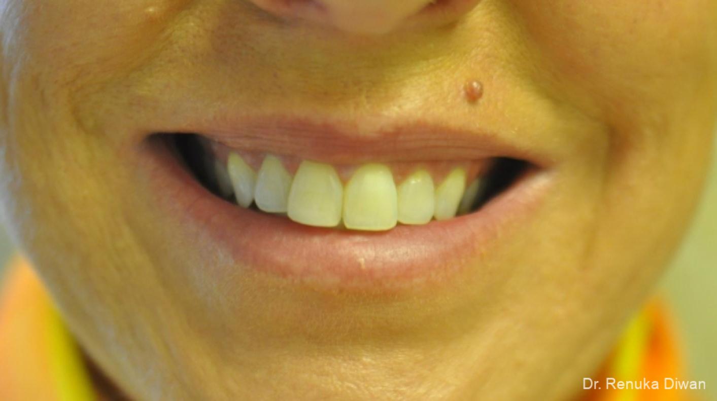 BOTOX® Cosmetic: Patient 30 - After 1