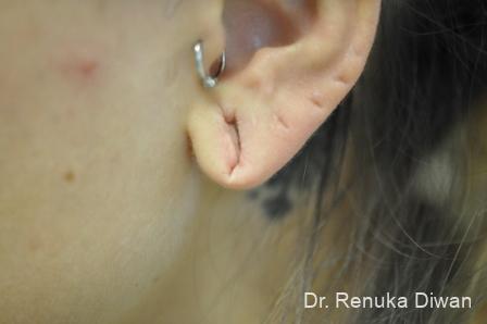 Earlobe Surgery: Patient 6 - Before 1