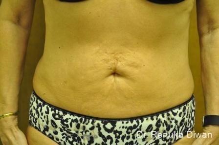 Liposuction: Patient 15 - After 1