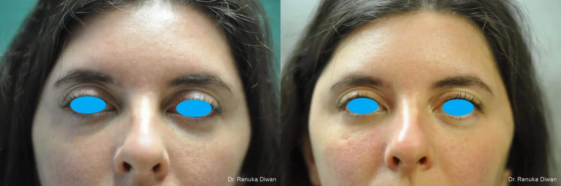 Dark Circles: Patient 26 - Before and After 1