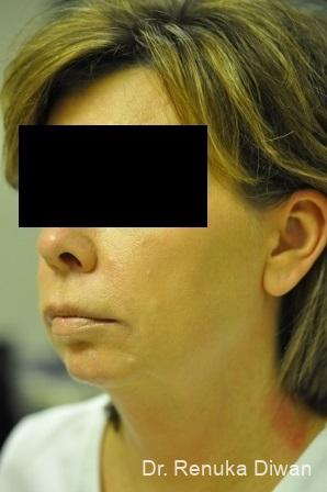 Chin Augmentation: Patient 1 - Before 1