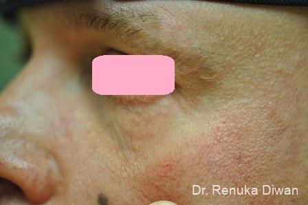 Laser For Veins And Redness: Patient 11 - After 1