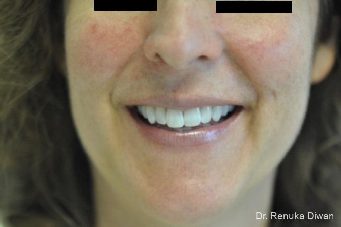 Laser For Veins And Redness: Patient 8 - Before 1