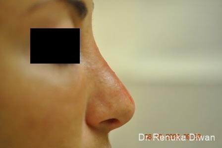 Non-Surgical Rhinoplasty: Patient 2 - After  