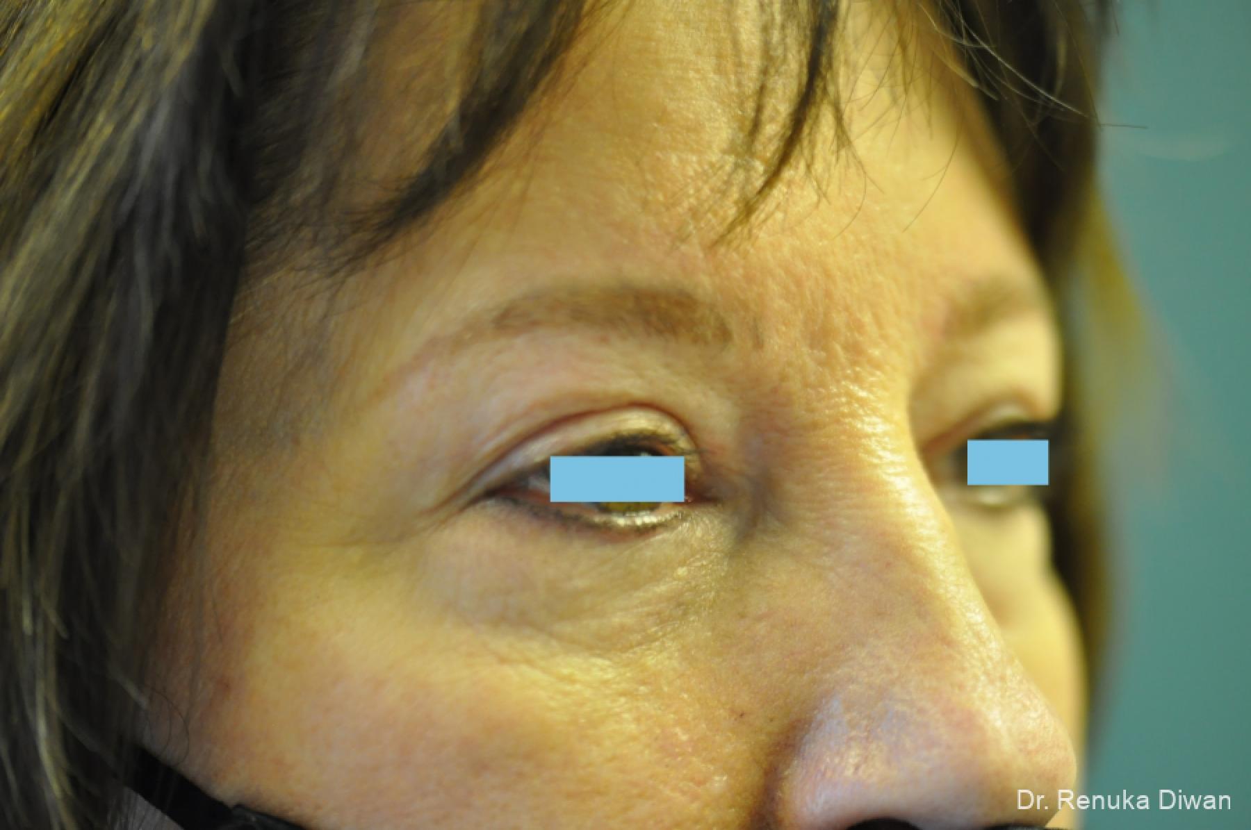 Blepharoplasty: Patient 3 - After 2