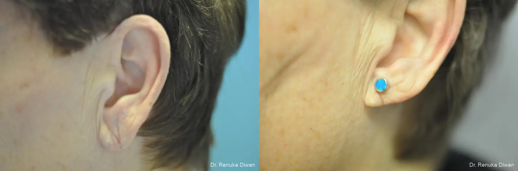 Earlobe Surgery: Patient 10 - Before and After 1