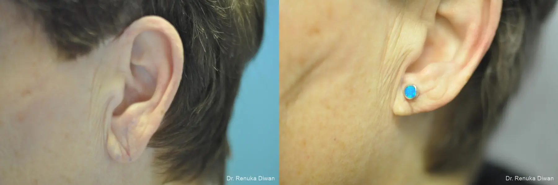 Earlobe Surgery: Patient 9 - Before and After  