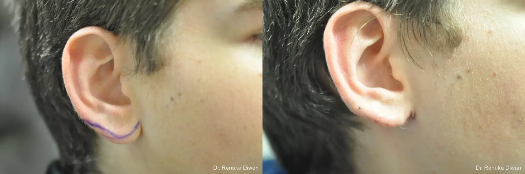 Earlobe Surgery: Patient 10 - Before and After 1