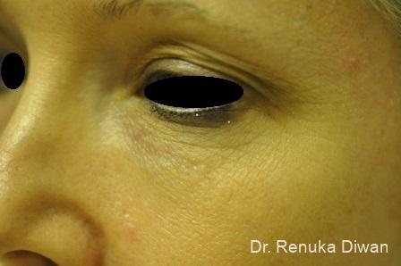 Laser Skin Resurfacing: Patient 3 - Before 