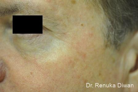 Botox-cosmetic-for-men: Patient 5 - After  