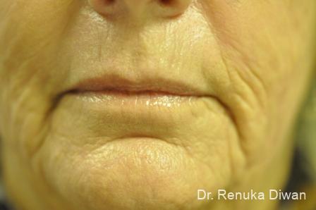 Laser Skin Resurfacing: Patient 6 - After 2