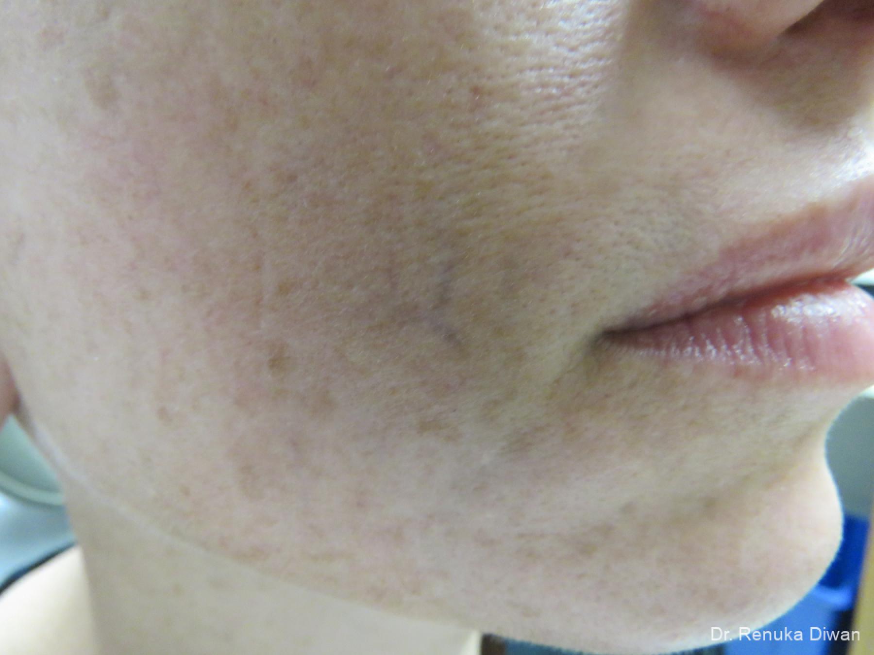 Laser For Veins And Redness: Patient 35 - Before 1
