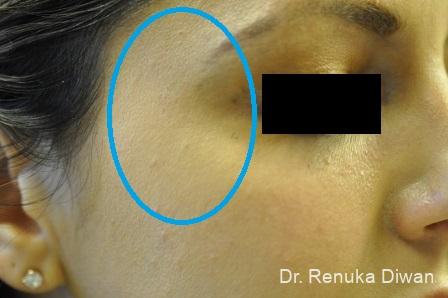 Chemical Peel: Patient 2 - After 1