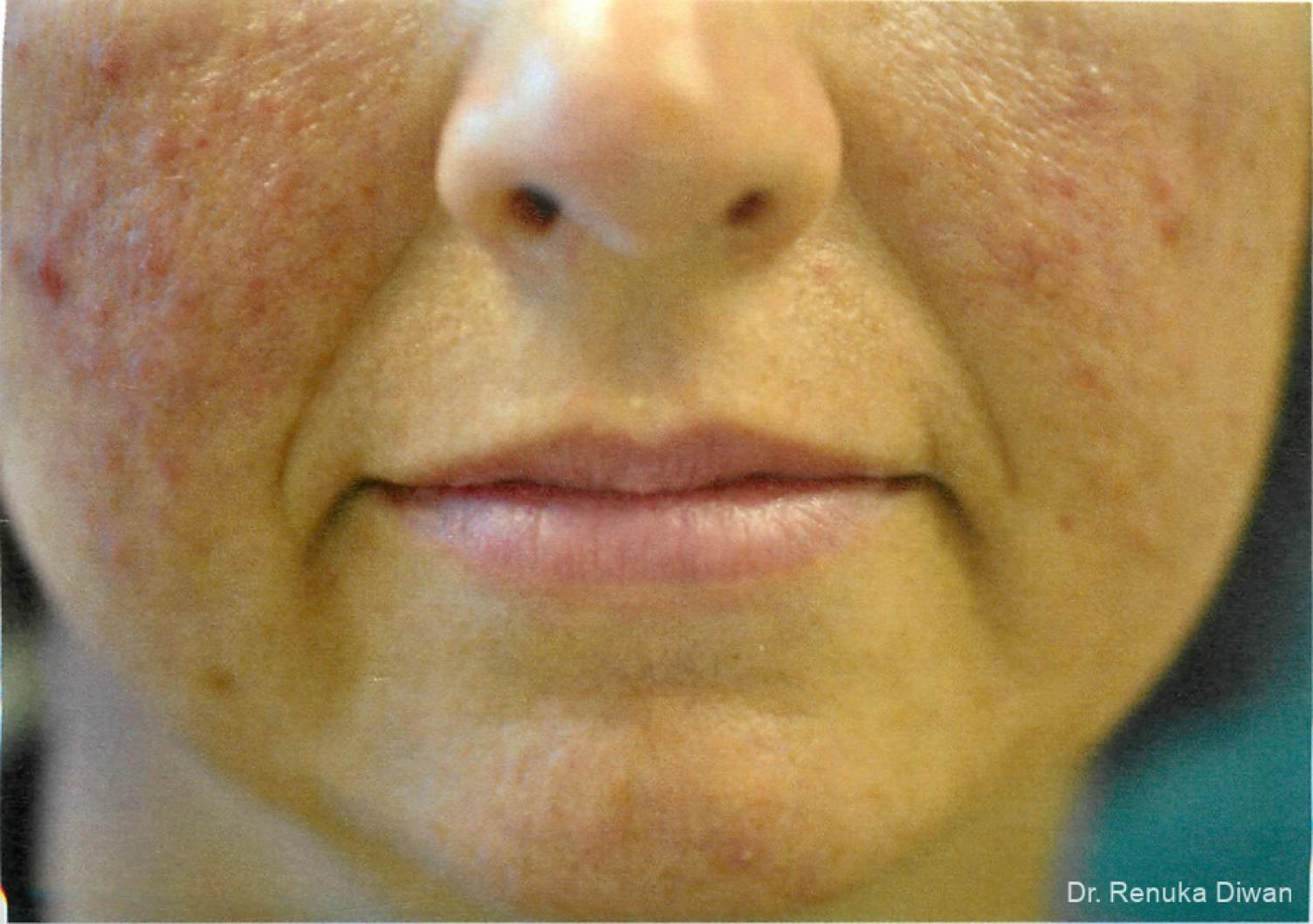 Marionette Lines: Patient 5 - Before 