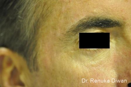 Botox Cosmetic For Men: Patient 6 - After 1