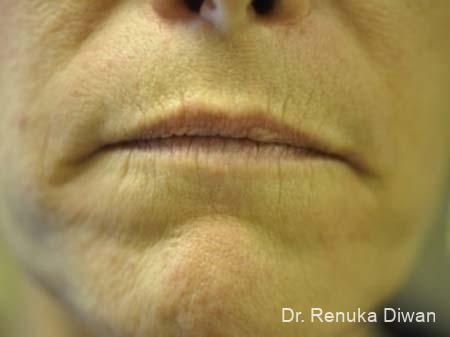 Lips And Mouth: Patient 4 - Before 