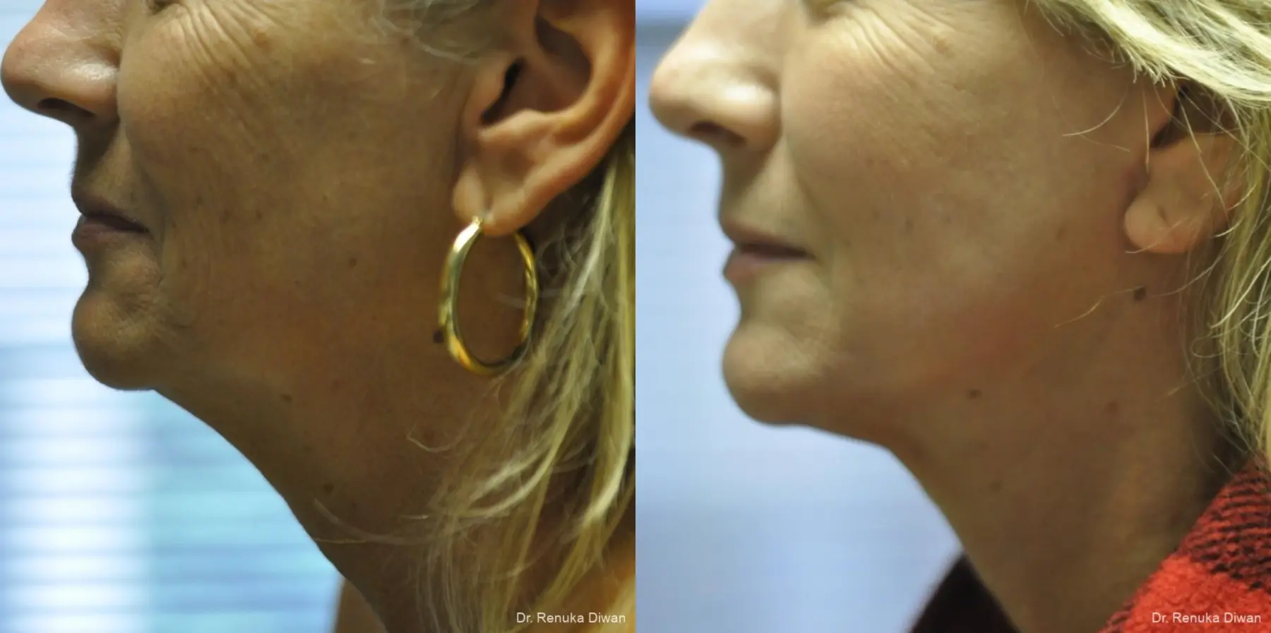 Facelift: Patient 13 - Before and After 1