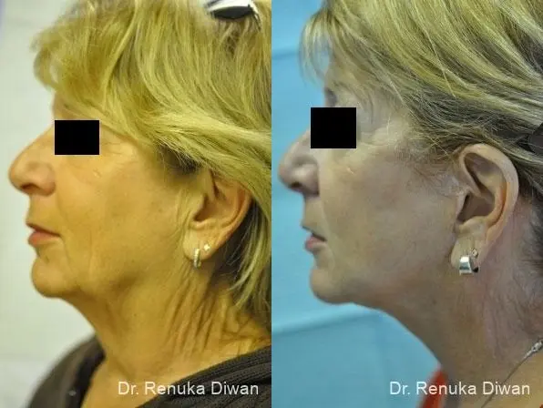 Facelift: Patient 2 - Before and After 2