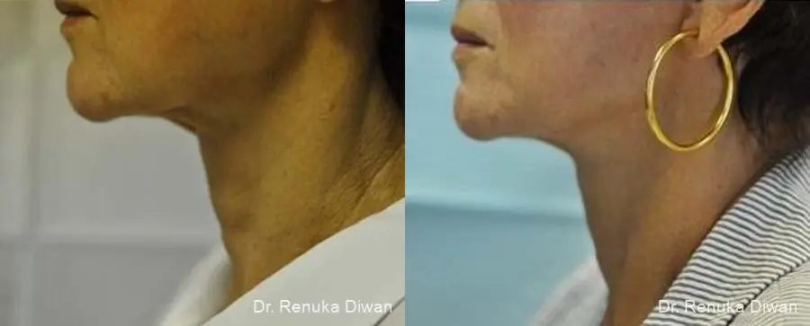 Facelift: Patient 3 - Before and After  