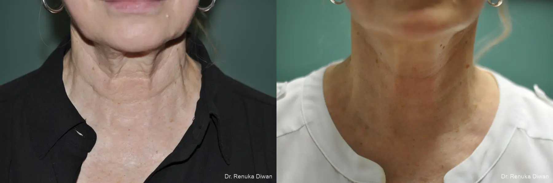 Facelift: Patient 15 - Before and After 1