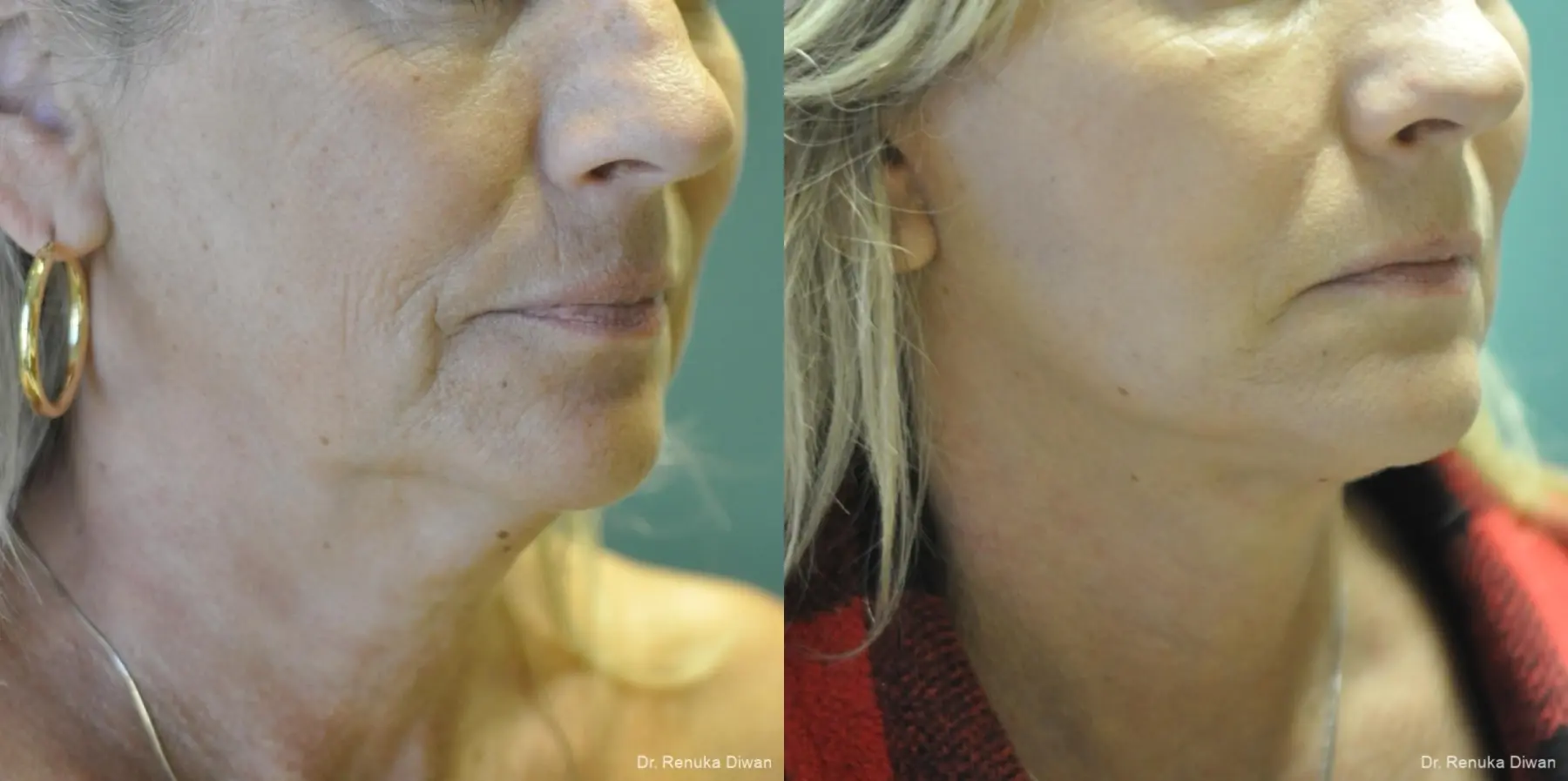 Facelift: Patient 13 - Before and After 2