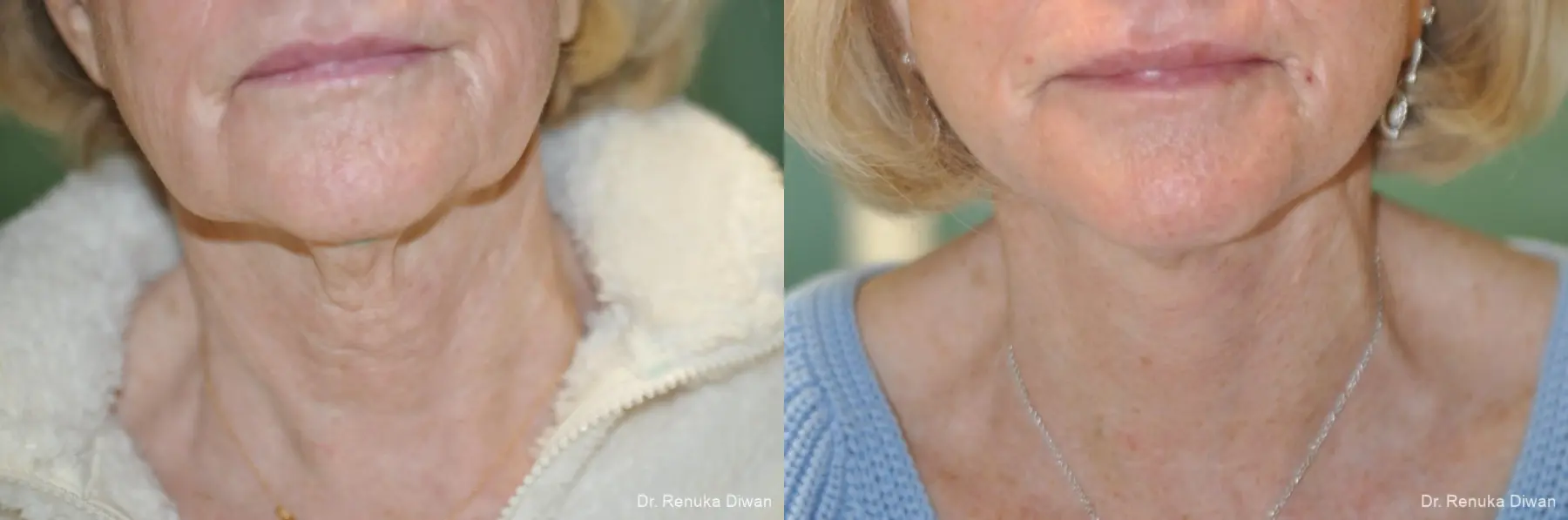 Facelift: Patient 16 - Before and After 1