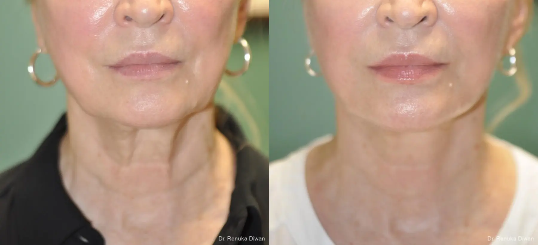 Facelift: Patient 15 - Before and After 2