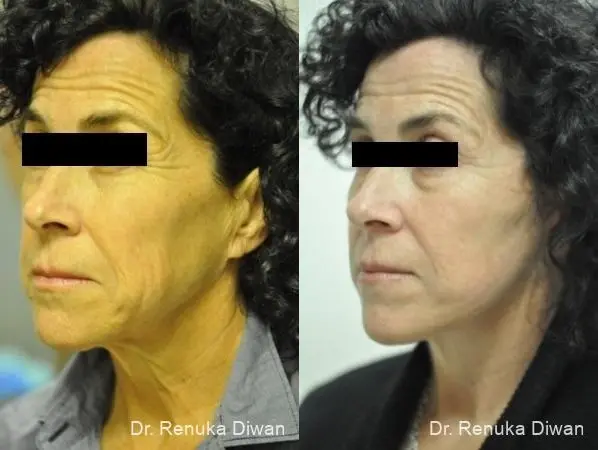 Facelift: Patient 12 - Before and After 1