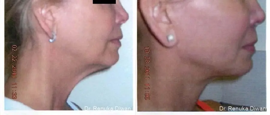 Facelift: Patient 4 - Before and After 1