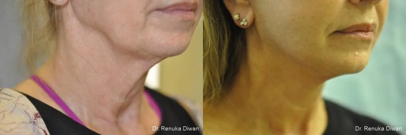 Facelift: Patient 11 - Before and After 1