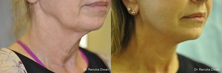 Facelift: Patient 11 - Before and After 1