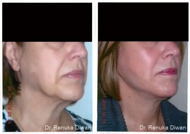 Facelift: Patient 7 - Before and After 1