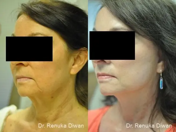 Facelift: Patient 1 - Before and After 1