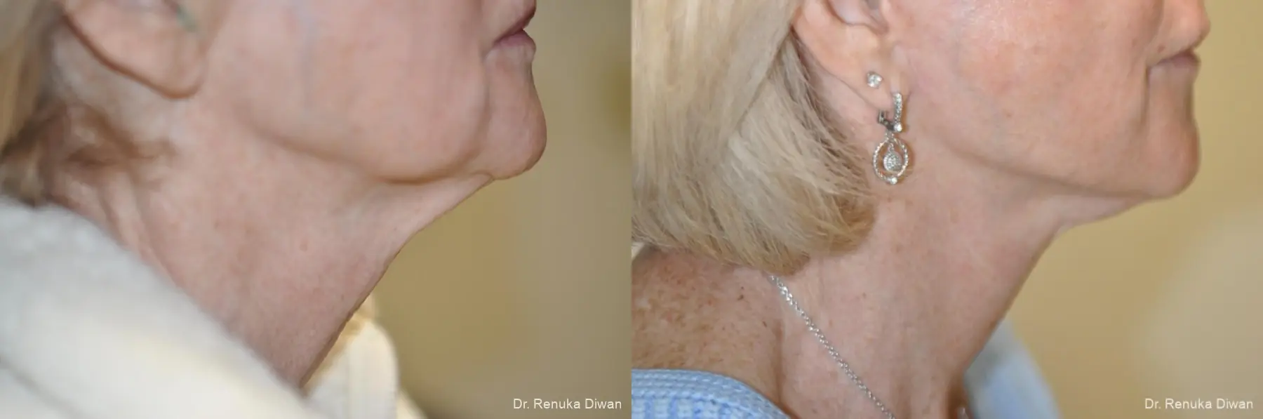 Facelift: Patient 16 - Before and After 3