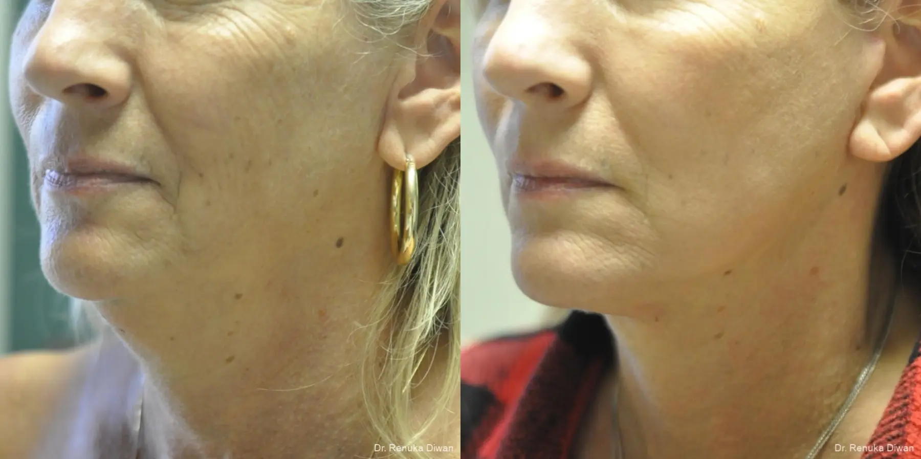 Facelift: Patient 13 - Before and After 3